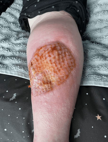 Туристку в Италии укусил паук укус ядовитого паука